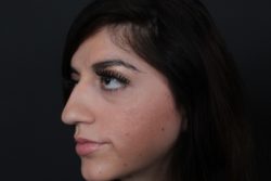 Rhinoplasty