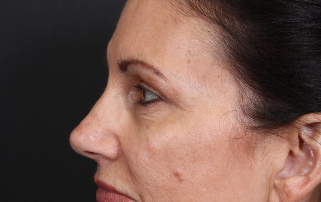 Eyelid Surgery