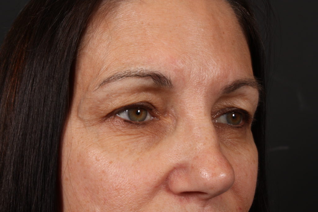 Eyelid Surgery