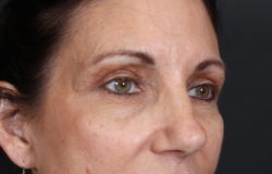 Eyelid Surgery