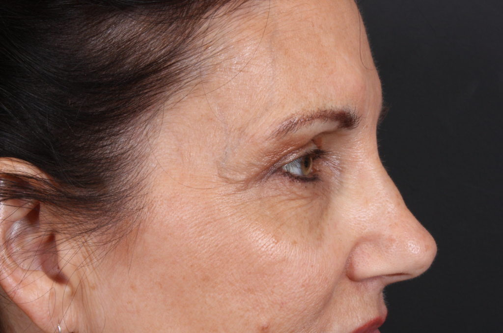 Eyelid Surgery