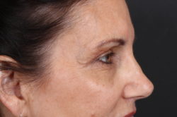 Eyelid Surgery