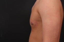 Gynecomastia