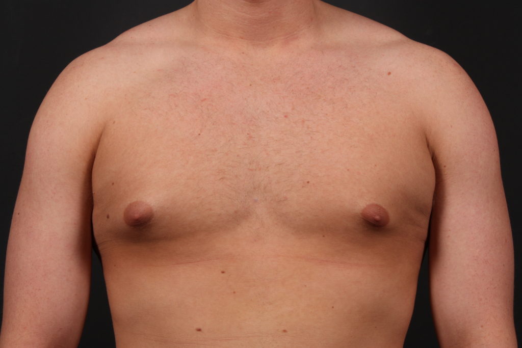 Gynecomastia