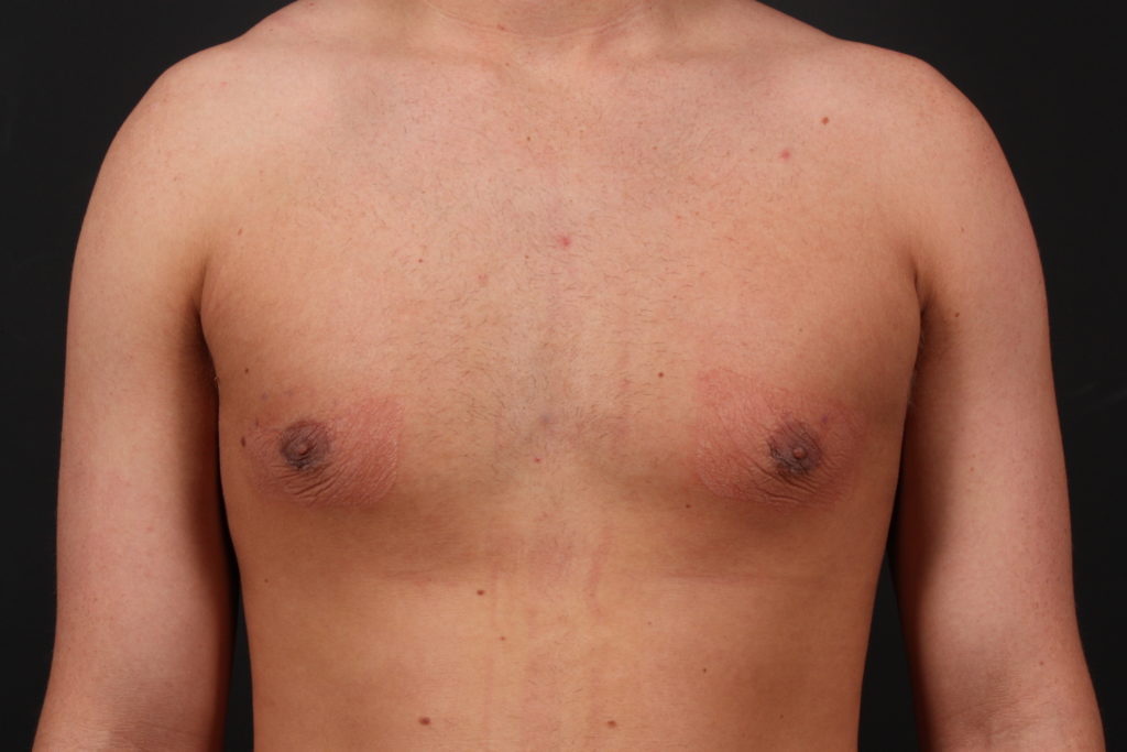 Gynecomastia