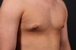 Gynecomastia