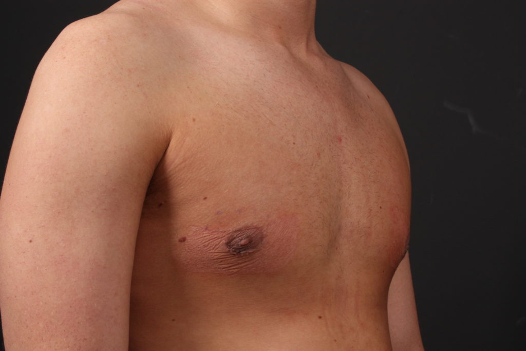 Gynecomastia