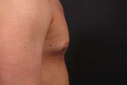 Gynecomastia