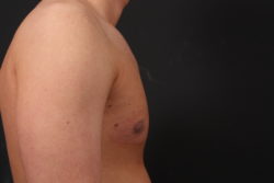 Gynecomastia