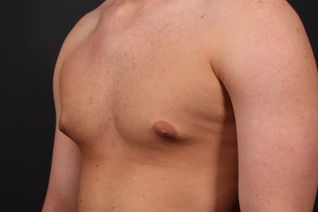 Gynecomastia