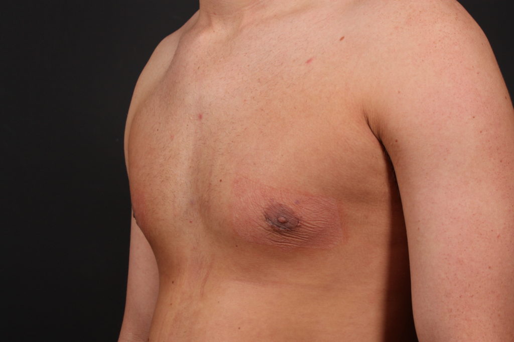 Gynecomastia