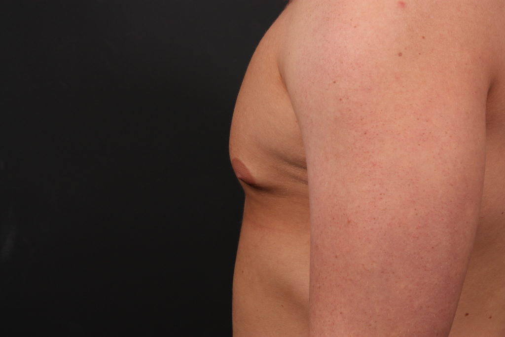 Gynecomastia