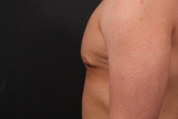 Gynecomastia