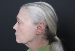 Ear Reduction/Otoplasty