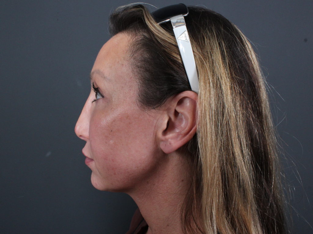 Rhinoplasty