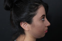 Rhinoplasty