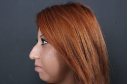 Rhinoplasty