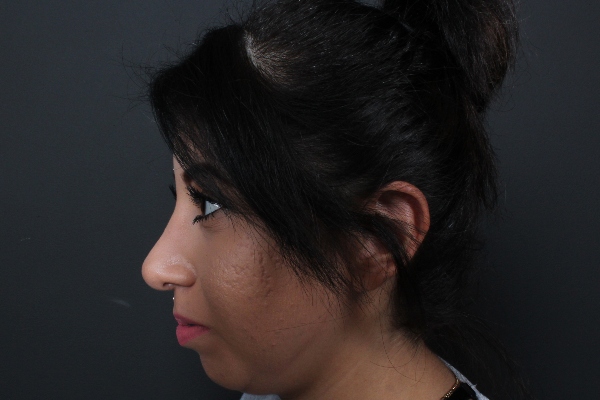 Rhinoplasty