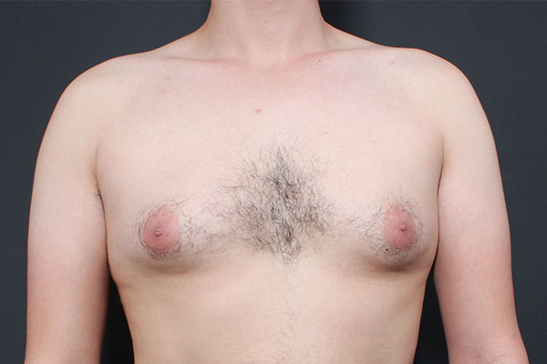 Gynecomastia