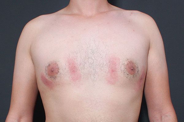 Gynecomastia