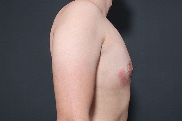 Gynecomastia