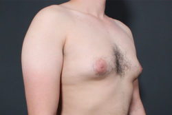 Gynecomastia