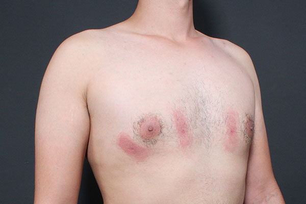 Gynecomastia