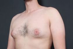 Gynecomastia