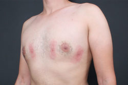 Gynecomastia