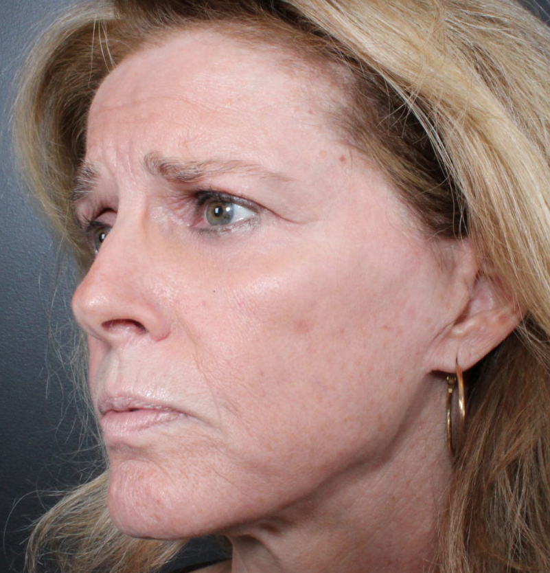 Facelift