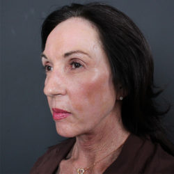 Laser Resurfacing