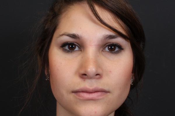 Rhinoplasty