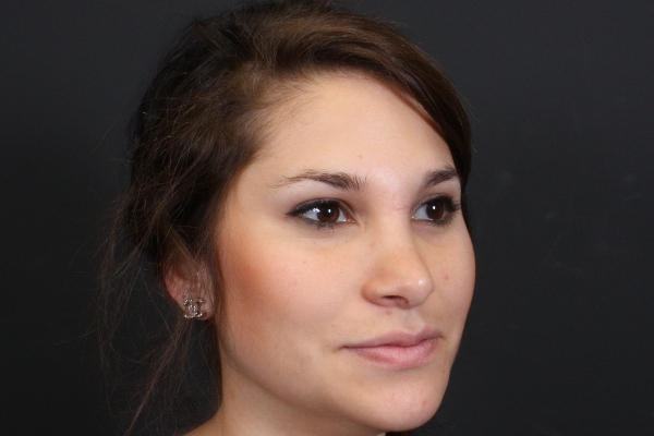 Rhinoplasty