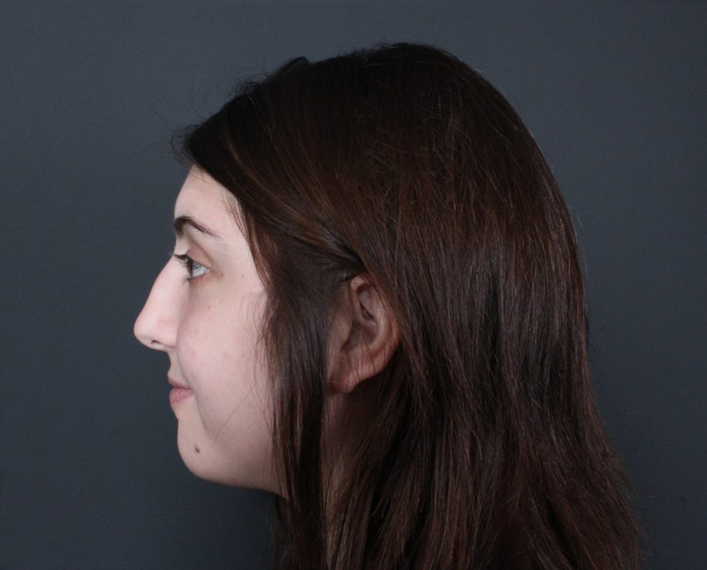 Rhinoplasty