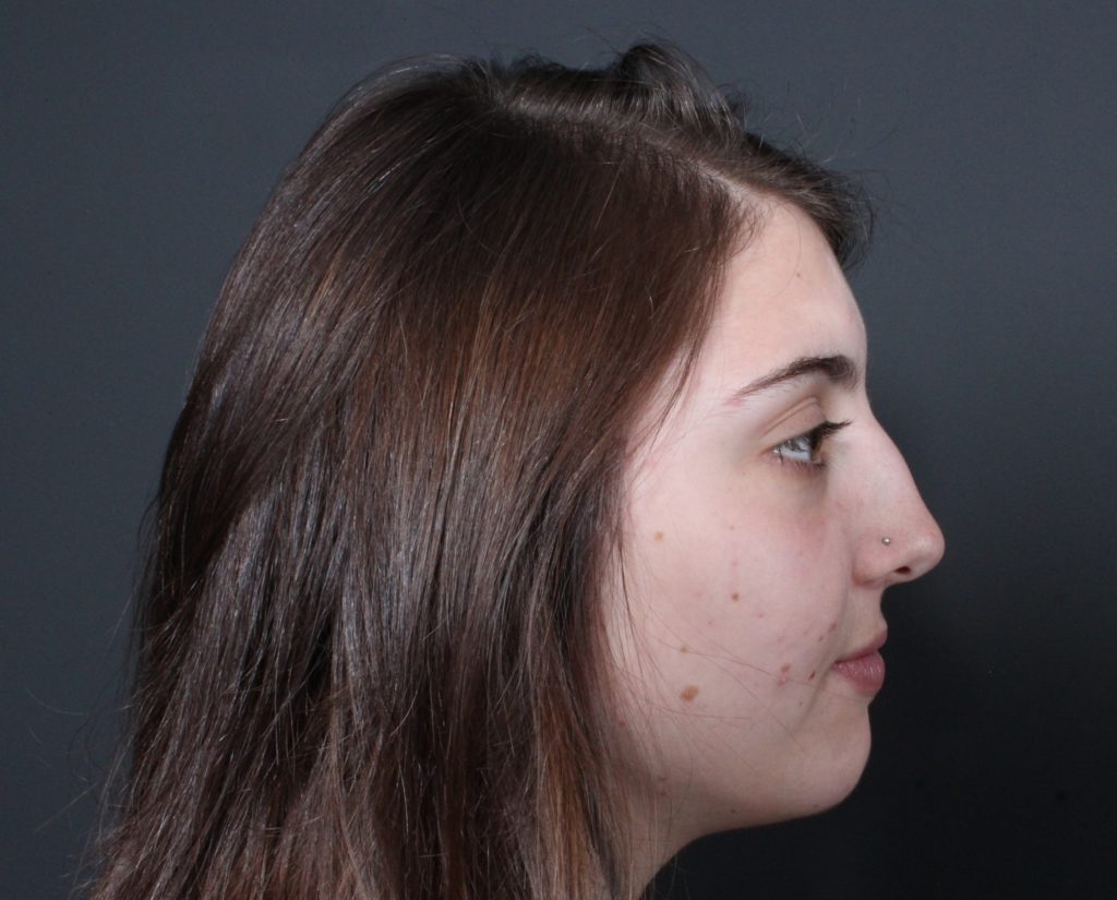 Rhinoplasty