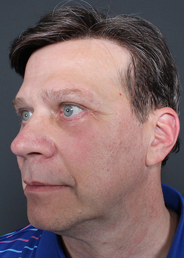 Eyelid Surgery