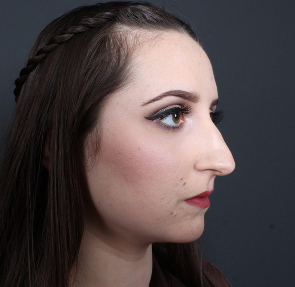 Rhinoplasty