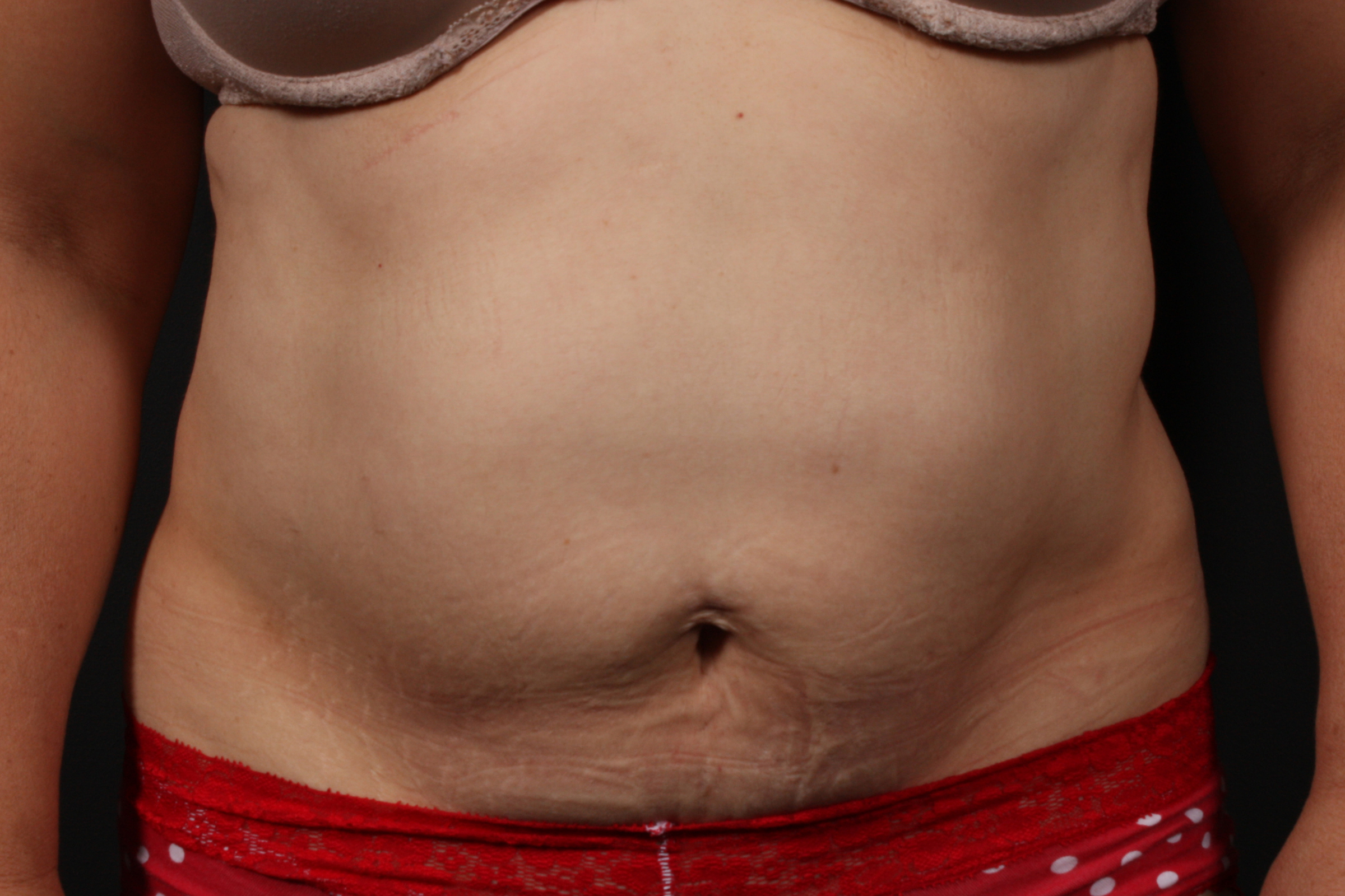 Tummy Tuck