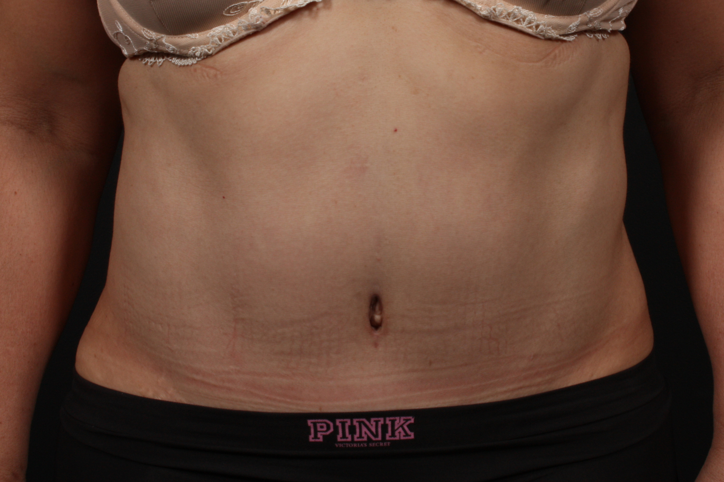 Tummy Tuck