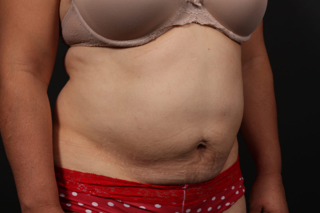 Tummy Tuck