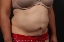 Tummy Tuck