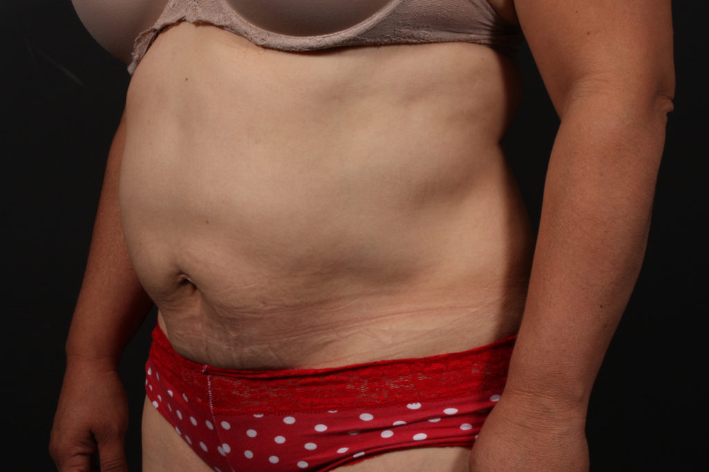 Tummy Tuck