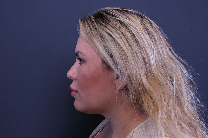 Facetite