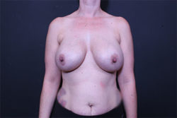 Breast Reconstruction