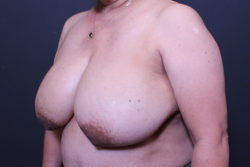 Breast Reconstruction