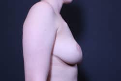 Breast Reconstruction