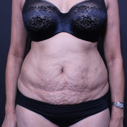 Tummy Tuck