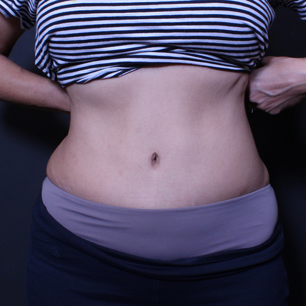 Tummy Tuck