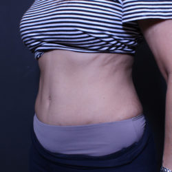 Tummy Tuck