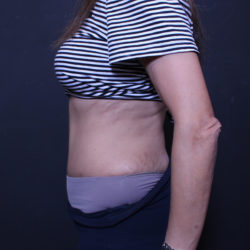 Tummy Tuck